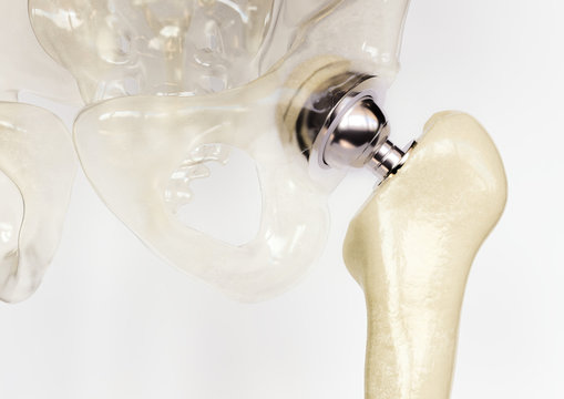 Artificial hip joint after severe osteoarthritis - 3D Rendering