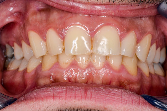 leichte gingivitis, kapillaren in die papillen einwachsend