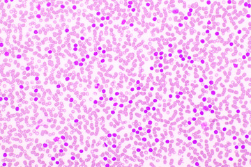 Picture of acute lymphocytic leukemia or ALL cells in blood smear, analyze by microscope, 400x