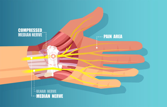 vector of a carpal tunnel syndrome with median nerve compression