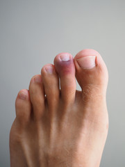 A bruise on the toe. Injury, arthritis, rheumatism, disease concept..