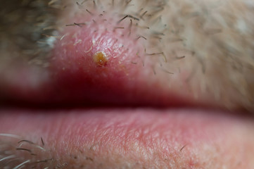 Herpes on the upper lip of a man. Macro. Soft focus, shallow depth of field.