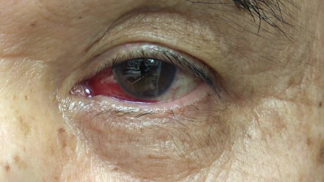 充血した目 白内障手術後 4K / Red bloodshot eye with a little scar from cataract surgery