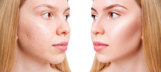 Face of beautiful woman before and after acne treatment.