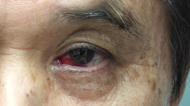 充血した目 白内障手術後 4K / Red bloodshot eye with a little scar from cataract surgery