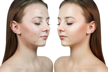 Face of beautiful woman before and after acne treatment.