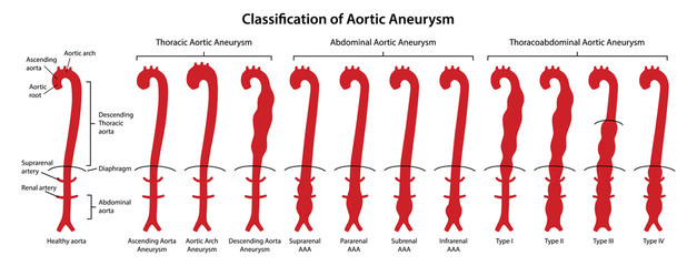 Classification of Aortic Aneurysms. Healthy aorta with main parts labeled and aorta with various types of aneurysm. Vector illustration in flat style isolated on white background