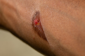 Fototapeta premium A burn mark in a black skin arm