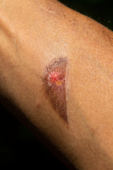 Fototapeta premium A burn mark in a black skin arm