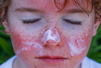red painful skin, sunburn on the boy's face, sunburn protection need, close-up face of a cute caucasian boy with a sunscreen on his nose, which burned in the sun, freckles face