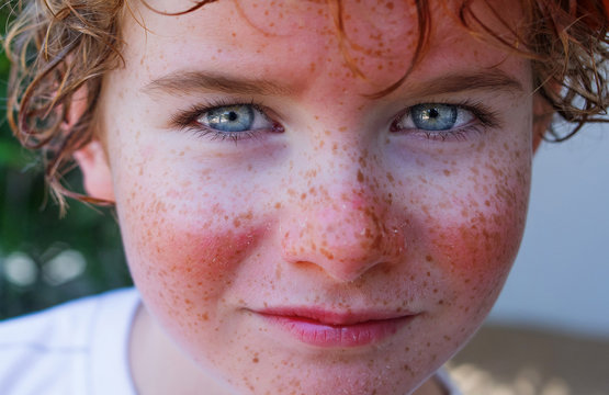 red painful skin, sunburn on the boy's face, sunburn protection need, close-up face of a cute caucasian boy with a sunscreen on his nose, which burned in the sun, freckles face