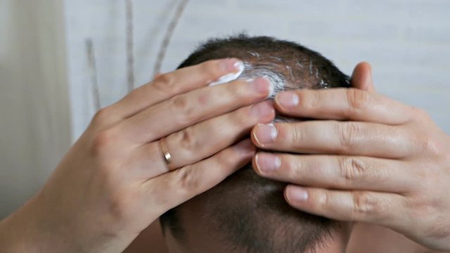 Fight against hair loss in men. Shots to the head. Treatment of male pattern baldness. Early hair loss. A man uses a cream hair growth