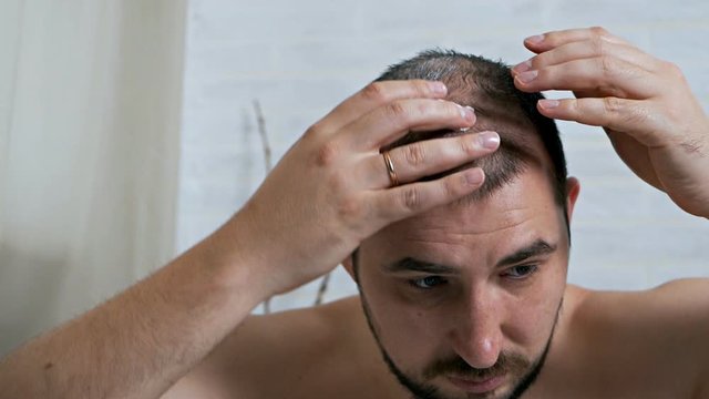Fight against hair loss in men. Shots to the head. Treatment of male pattern baldness. Early hair loss. A man uses a cream hair growth