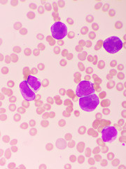 Acute promyelocytic leukemia cells or APL, analyze by microscope, original magnification 1000x