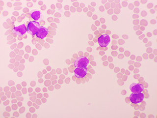 Acute promyelocytic leukemia cells or APL, analyze by microscope, original magnification 1000x