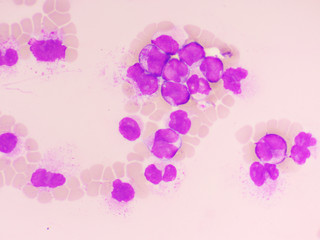 Acute promyelocytic leukemia cells or APL, analyze by microscope, original magnification 1000x