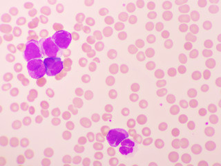 Acute promyelocytic leukemia cells or APL, analyze by microscope, original magnification 1000x