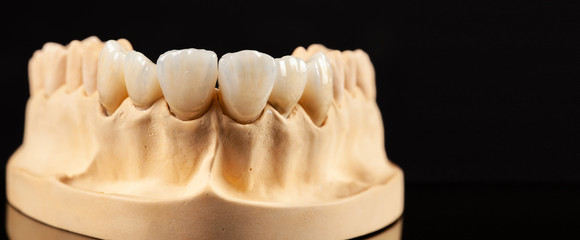 Fototapeta na wymiar Close-up view of dental layout of upper veneers of teeth prothesis