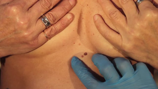 control of moles on the breast by a doctor wearing blue gloves on a female patient palpating the mole