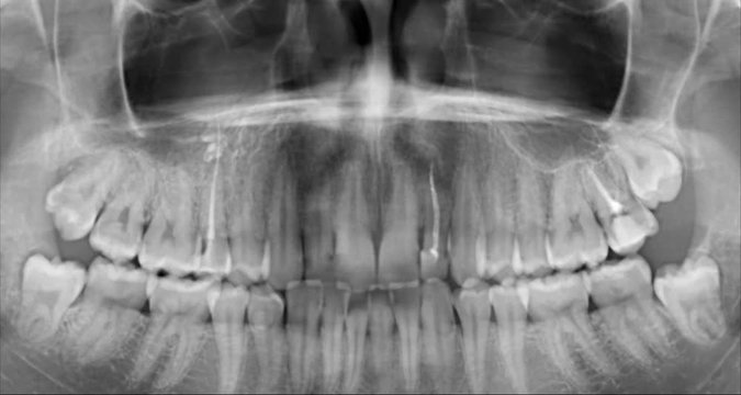 Panoramic x-ray of the jaw. X-ray picture of the girl's teeth