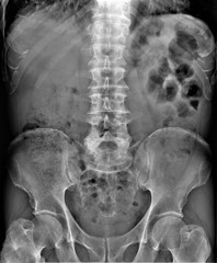 radiography of lumbar and sacral spine, pelvis, coxarthrosis, medical diagnostics