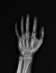 normal x-ray of the hand bones and fingers,orthopedics, medical diagnostics, rheumatology