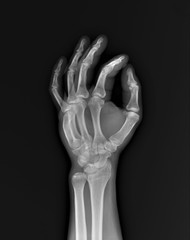 normal x-ray of the hand bones and fingers,orthopedics, medical diagnostics, rheumatology