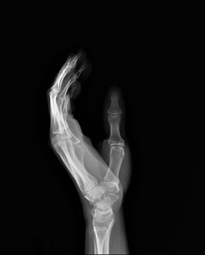 Normal X-ray Of The Hand Bones And Fingers,orthopedics, Medical Diagnostics, Rheumatology