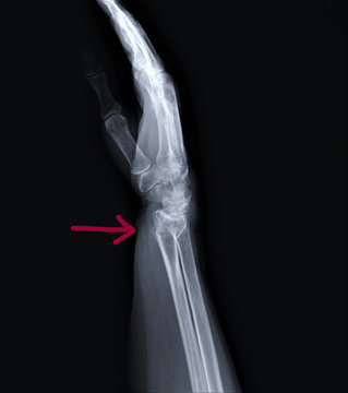 radiography of forearm and wrist bones   with a fracture of the distal radius, Traumatology and orthopedics