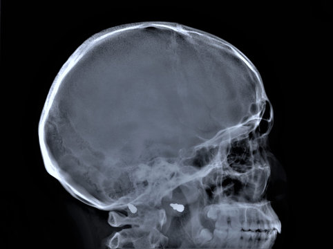 normal radiography of the skull in lateral projection in yellow medical diagnostics, traumatology and orthopedics, neurosurgery