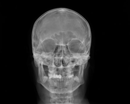 normal x-ray of the skull in direct projection, medical diagnostics, traumatology and orthopedics, neurosurgery