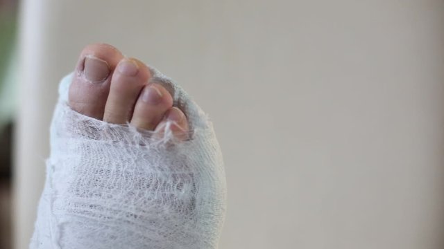 male leg in a plaster cast. toes moving. plain background, close-up.