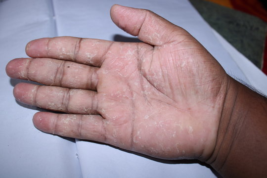 Skin Diseases Psoriasis On The Palm. 