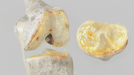 stronger arthritis - stage 2 - on the knee joint - high degree of detail - 3D Rendering