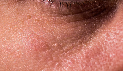 Naklejka premium Skin aging under the eye. Eyelids in wrinkled wrinkles. Near