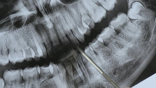 Panoramic tomography of the jaw close-up. The orthodontist analyzes the bite for dental treatment.