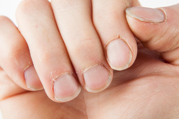 Dirty and neglected hand and damaged and overgrown nails of an adult male, isolated on a white background.
