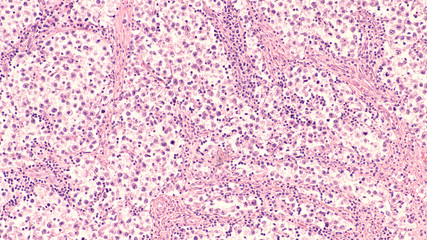 Testicular Cancer: Photomicrograph of seminoma, a malignant germ cell tumor of the testis...