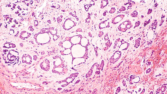 Photomicrograph of an adenoid cystic carcinoma, a rare type of cancer which usually occurs in salivary glands, but may also occur in other locations, such as the bronchus of lung, as in this case.  