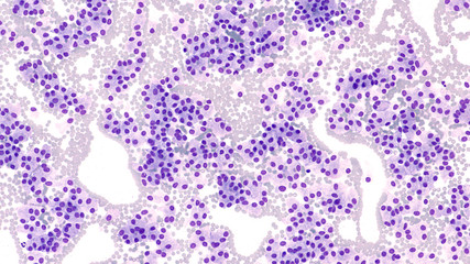 Fine needle aspiration (FNA) cytology of a bronchial carcinoid tumor, a type of neuroendocrine tumor, obtained during an endobronchial ultrasound (EBUS) procedure.  