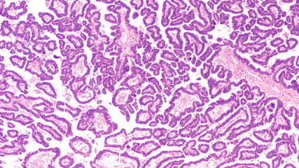 Ovarian Cancer Awareness: Micrograph of a serous papillary carcinoma (adenocarcinoma) of ovary,...