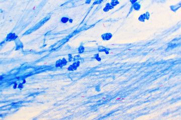 Mycobacterium tuberculosis positive (small red rod) in sputum smear, acid-fast stain, analyze by microscope