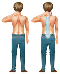 Back of man with spinal nerve problem