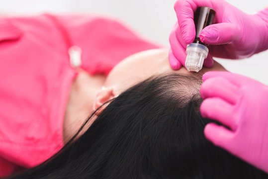 Derma roller cosmetic microdermabrasion instrument for hair
