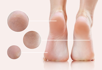 Zoom circles shows callus treatment result on feet.