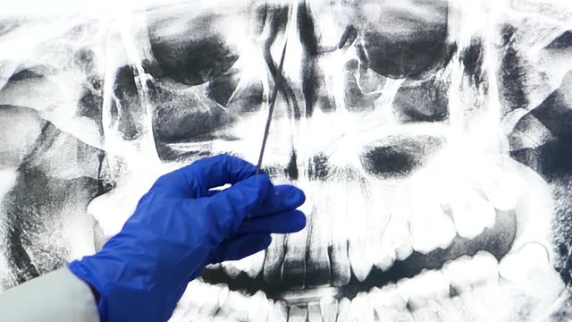 Panoramic tomography of the jaw and sinuses. The doctor's hand shows an x ray shot on the screen.