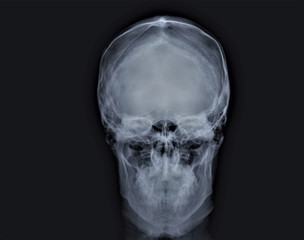 normal x-ray of the skull in direct projection, medical diagnostics, traumatology and orthopedics, neurosurgery