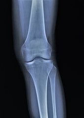 normal radiography of the knee joint in direct projection, medical diagnostics, Traumatology and orthopedics
