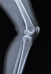 normal radiography of the knee joint in lateral projection, medical diagnostics, traumatology and orthopedics