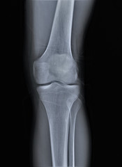 normal radiography of the knee joint in direct projection, medical diagnostics, Traumatology and orthopedics